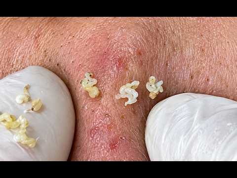 NEW 2026 – Satisfying Acne & Pimple Removal 😱#10329