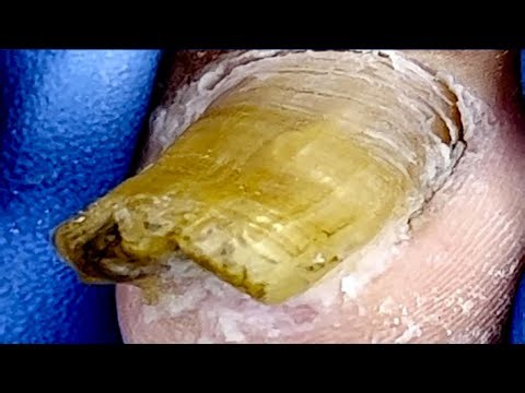 Extra Thick Onychomycosis Trimming And Ingrown Toenail Separation【Podiatry Clinic】