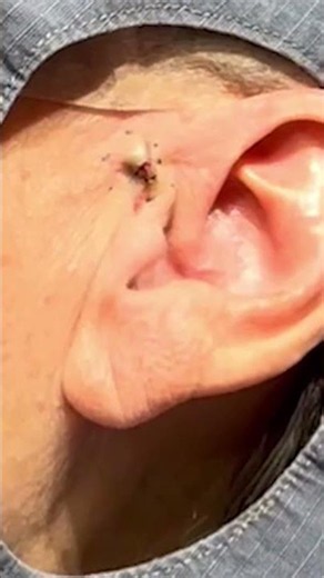 This Stuck in His Ear for Years