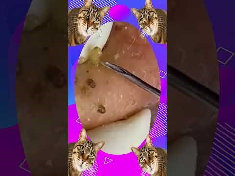 Blackheads Removal #380 | Acne Treatment and Very Satisfying Satisfying Pimple pop #blackheads