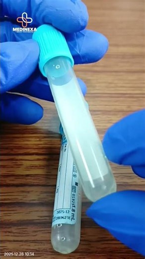 PT INR Test || Which Vial is Used for PT INR? || Citrate Blue Top Tube ||