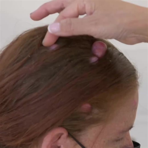 Dr. Pimple Popper: Satisfying Before and After Results