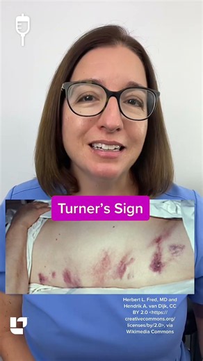 Cathy Explains - Turner’s sign: Medical Surgical SHORT | @LevelUpRN