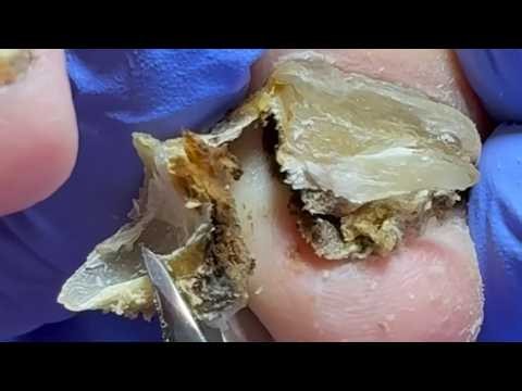Remove The Dirt Under Your Nails Step By Step, The Effect Is Amazing!【Xue Yidao】