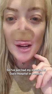 "Turkey Teeth" ruined my face 😱🦷 #turkeyteeth, #botchedsurgery, #dentalimplants