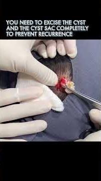 This Cyst is How Old!?