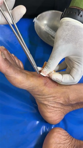 Large Wooden Splinter Removed from the Foot | Unexpected Foreign Body Removal #Shorts #medical