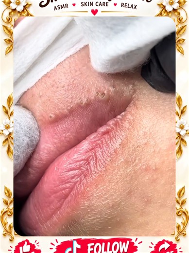 Deep Blackhead Extraction & Satisfying Popping | Wait for the most satisfying pop 😳🫣 You won’t believe what comes out! #pimplepoppersatisfying #Acne #pimple #Blackhead #Satisfying