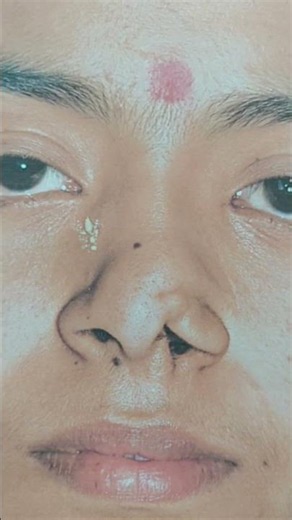 Professional Nose Job: Before, During & After #rhinoplasty #surgery #transformation