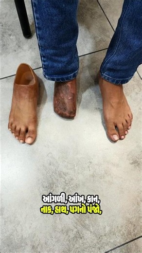 what is Prosthetics??? #ArtificialLimb #Prostheticleg