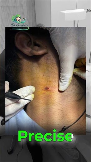 Sebaceous Cyst Removal | Small Swelling Removed in Minutes (Minimal Scar)