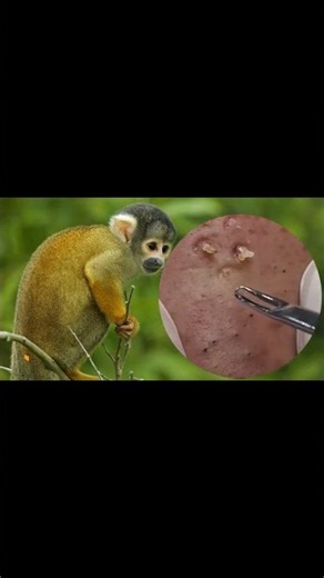 Removing Acne Blackheads on skin, cleaning everywhere