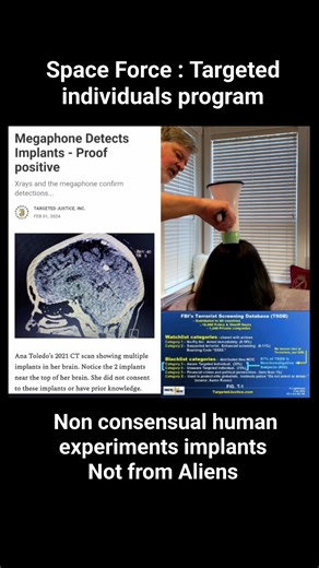 People are finding implants in there heads arms and teeth fillings and the implants are also self assembling from the different injectables that contains nanotech. Many many people who report being abducted by Aliens 👽 they are actually human experiments guinea pigs for Trumps Space force . ELECTRONICS EMF and 6g used to torture them 😢 and wear them down so they will accept the NEw World Order ....DO NOT comply NO MATTER WHAT . | Nalbachone Cody