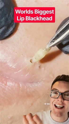 Greatest Ever LIP BLACKHEAD REMOVAL - Biggest Blackhead 2026 #shorts