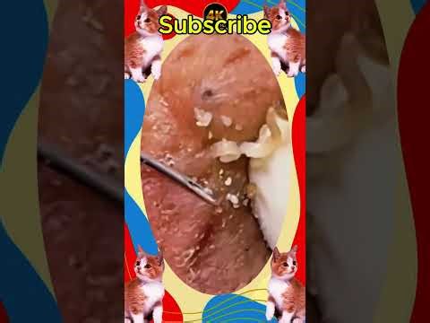 Blackheads Removal #191 | Acne Treatment and Very Satisfying Satisfying Pimple pop #blackheads