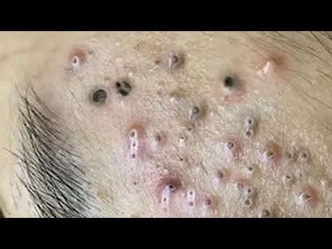Deep blackhead Removal 2026, acne removal spa, big pimple 2026, #acne #pimple #cyst