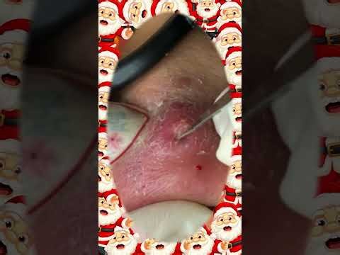 Blackheads Removal #664 | Acne Treatment and Very Satisfying Satisfying Pimple pop #blackheads