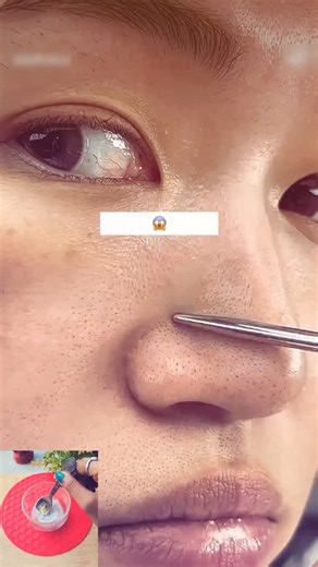 sunanda pradhan on Instagram: "Remove Blackheads Whiteheads Naturally at home 🏡 Blackheads Removal Pack 💯"