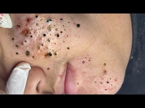 Satisfying Blackhead Removal – Deep Acne Cleaning for Ultimate Relaxation - 293432