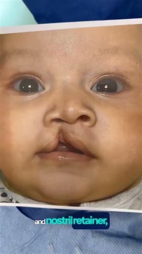 Cleft Lip Repair
