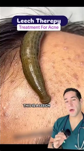 Doctor Reacts: leech therapy?!