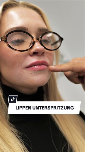 Heute gab es den ersten Lippenaufbau bei Dr. Pamirsad in Düsseldorf ✨ Verwendet wurde eine Technik, bei der die Lippenkontur sanft betont und die Lippe leicht nach außen gedreht wird. Dadurch wirken die Lippen voller, bleiben aber trotzdem natürlich und weich. Direkt nach der Behandlung ist eine leichte Schwellung ganz normal, diese geht in den nächsten Tagen Schritt für Schritt zurück 😊 Besonders wichtig war hier ein harmonisches Ergebnis, passend zum Gesicht und ohne künstlichen Effekt. ⚠️ Je
