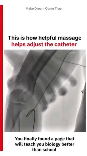 🦯 This is how helpful massage 🦵 helps adjust the catheter 🩺 | MDCT