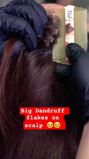 Asmr scalp scratching for dandruff #asmrscalpscratching #asmrscalp #scalpdandruff @CelainesASMR