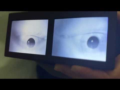 Short Term Central Adaptation of Vestibulo-Ocular Reflex during Left Dix Hallpiike Test