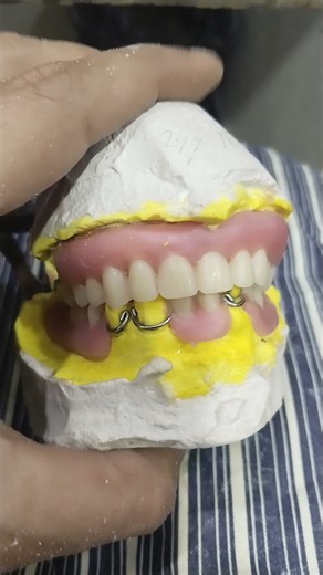 Upper Lower Removable Partial Denture Ready for Flasking 😁😁😁#viralvideo #dentalprosthesis