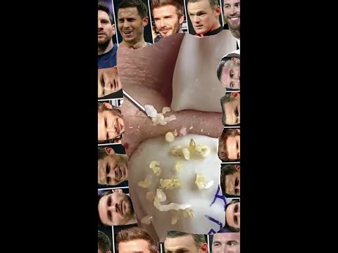 Blackheads Removal | Acne Treatment and Very Satisfying Satisfying Pimple pop #blackheads