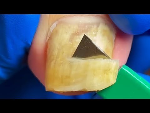 The Toenail Is Like A Beautiful Jade Stone, Cleans The Deep Pus【Xue Yidao】