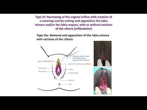 Female Genital Mutilation A Visual Reference and Learning Tool for Health