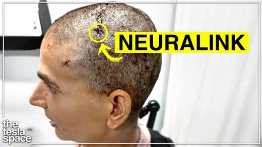 Elon Musk’s Neuralink just introduced its first female patient