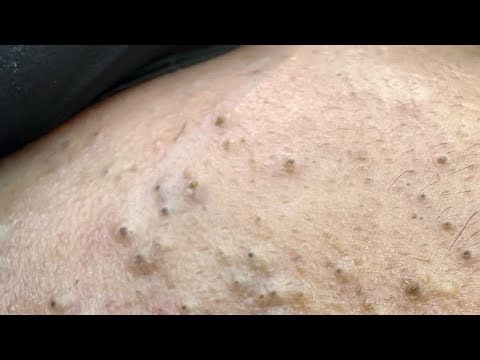 Deep Root Pimple Solution | Hidden Blemish Extraction Transformation
