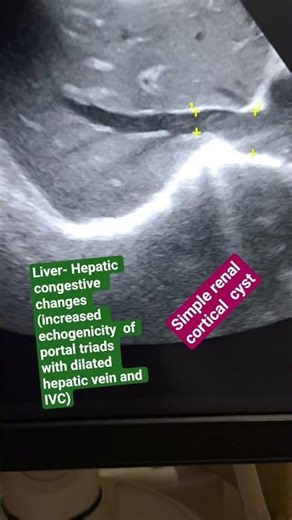 Hepatic congestive changes and simple renal cortical cyst