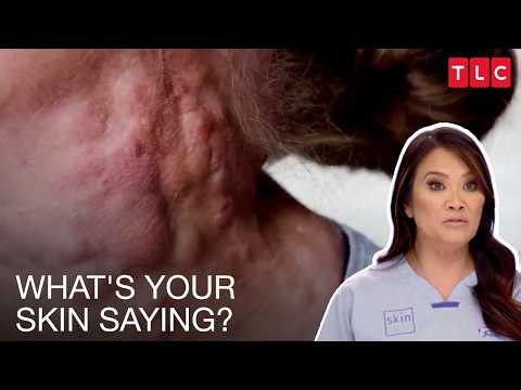 Dr. Sandra Lee Helps Patients Make Sense of Their Skin | Dr. Pimple Popper S3 & S2 | TLC India