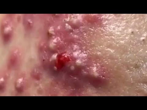 Deep blackhead Removal 2025, acne removal spa, big pimple 2025, #acne #pimple #cyst