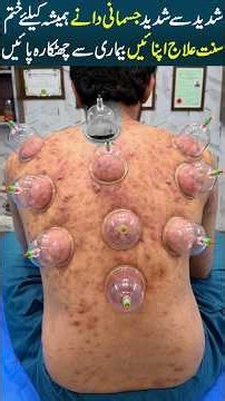 Hijama for Severe Back Pimples, Acne & Large Pus-Filled Bumps | Real Patient Session | Dr Usman Faiz