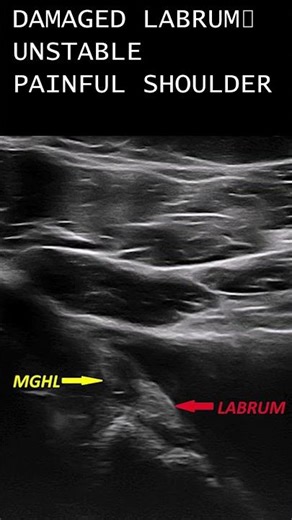 Shoulder keeps dislocating? Pain and instability explained – labrum tear and surgery results