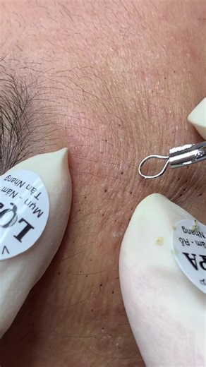 Chăm Sóc Da Mụn Hiệu Quả Tại LQ Spa