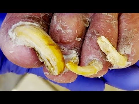 You've Never Seen Toenails So Long!【Dr. Liu's Pedicur】