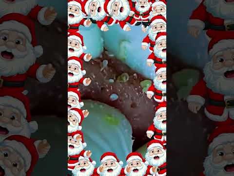 Blackheads Removal #384 | Acne Treatment and Very Satisfying Satisfying Pimple pop #blackheads