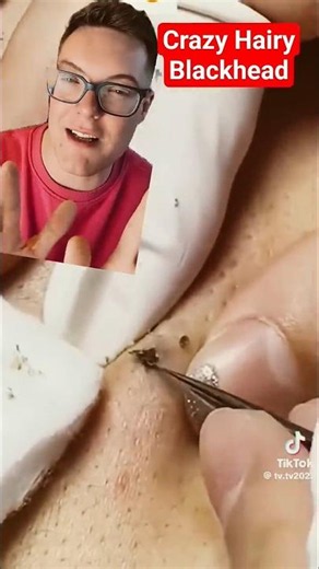 Crazy Hairy BLACKHEAD REMOVAL - How Does This Even Happen #shorts