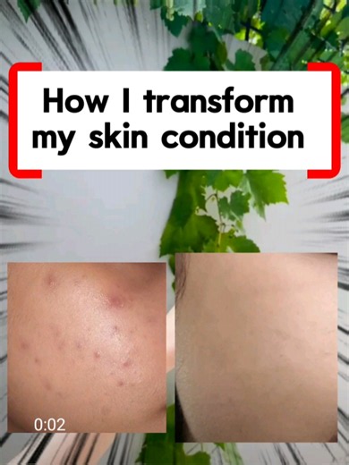 My Comedonal Acne Transformation ✨🤍 From comedone-prone skin to clearer skin! 🥹✨ This transformation took around 4 months, from December 2024 to March 2025. It wasn’t an overnight journey. It took consistency, patience, hard work, and learning from my mistakes along the way. 🤍 In my next video, I’ll share how you can treat comedones and which products you should use to get started with the right skincare routine. 🫶🏻 Follow for Part 2 of my comedonal acne treatment journey! 💗 . . . . . . . 