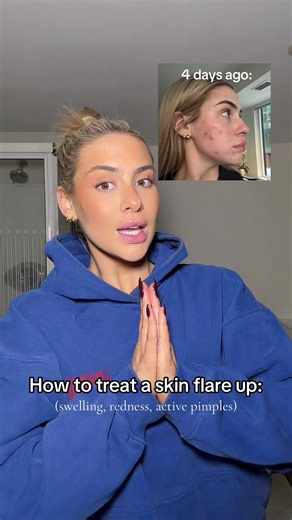 Skincare Tips: Managing Acne Flare-Ups Effectively