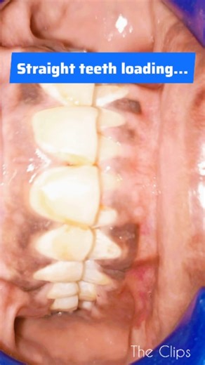 Raja Vka on Instagram: "Smile transformation in progress 😍 | Ortho Treatment Results that speak 😍 Alignment mode is the first and most important stage of orthodontic treatment. In this phase, we gently straighten crowded, rotated, or uneven teeth. Proper alignment is required to create space, balance the bite, and prepare teeth for the next stages like gap closure and finishing. This stage improves oral hygiene, reduces uneven tooth wear, and helps us achieve a stable, long-lasting smile. The 