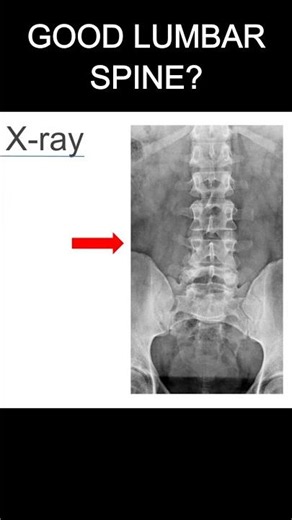 Lumbar Spine X-rays #1 | Part 1: Don’t Lose Marks
