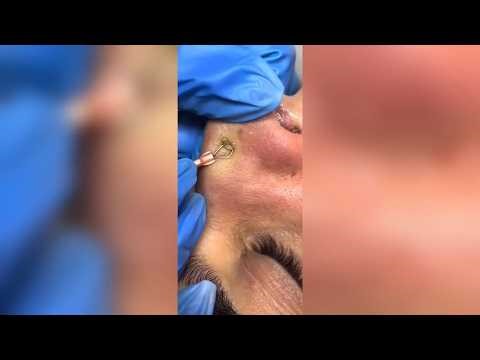 Satisfying Pimple Popping & Cyst Extractions - 180