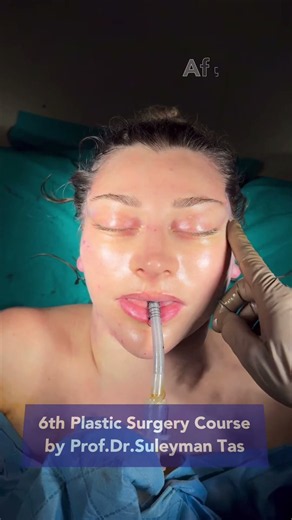 Live Scarless Face and Neck Lift at the 6th Plastic Surgery Course | Prof. Dr. Suleyman Tas